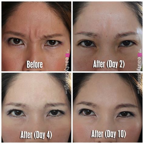 How to get rid of Forehead lines without Botox. . How to get rid of forehead bulge after botox